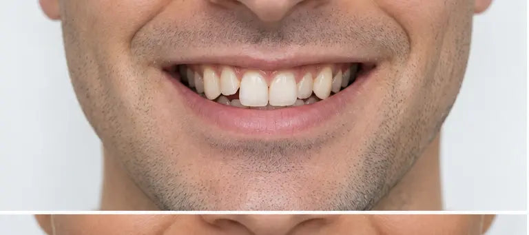 AI-generated smile before alignment — illustration, not a patient