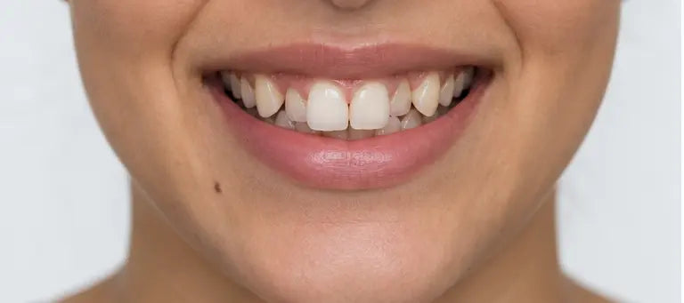AI-generated smile before alignment — illustration, not a patient
